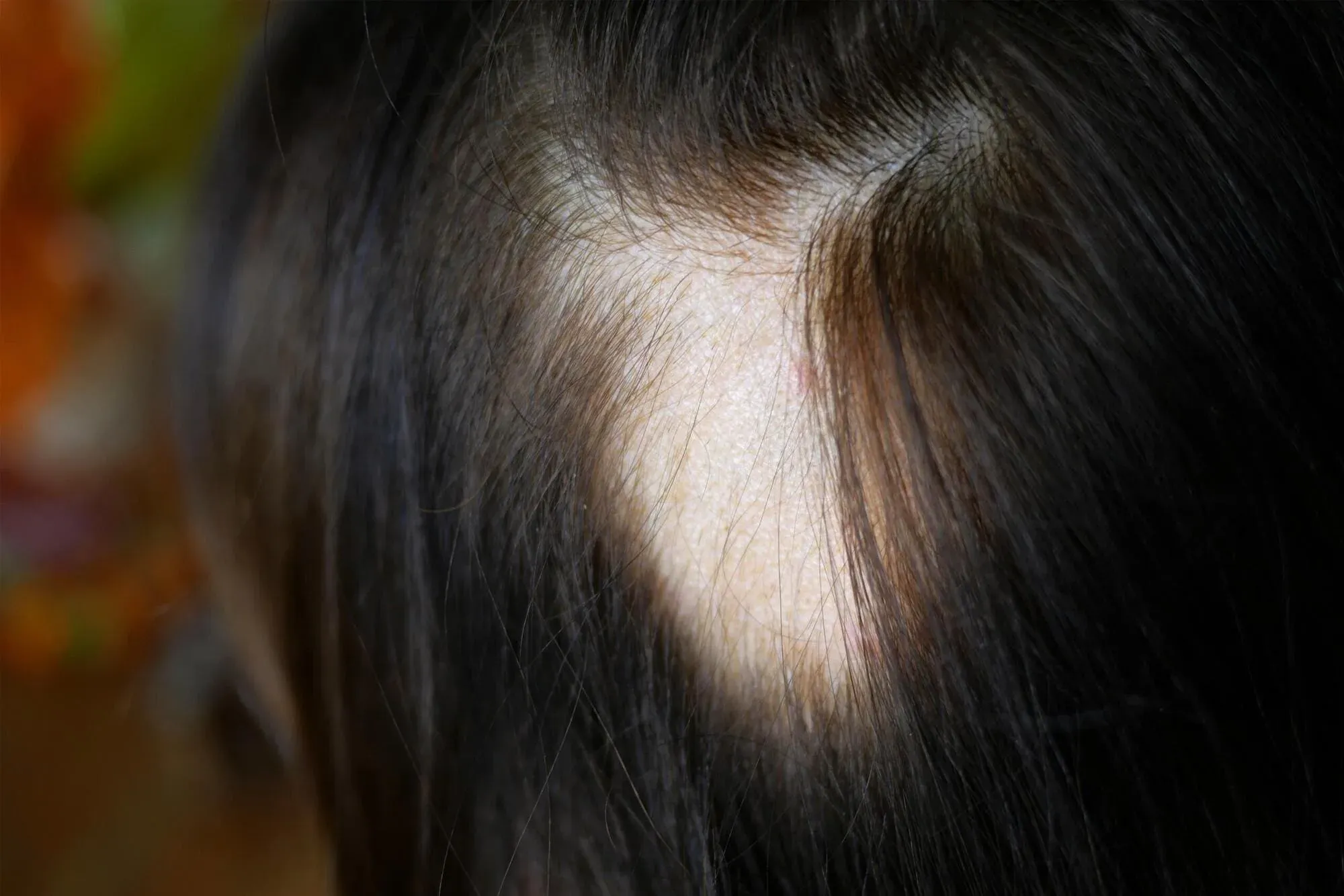 Apa Itu Autoimun Alopecia? Gejala, Penyebab & Solusinya