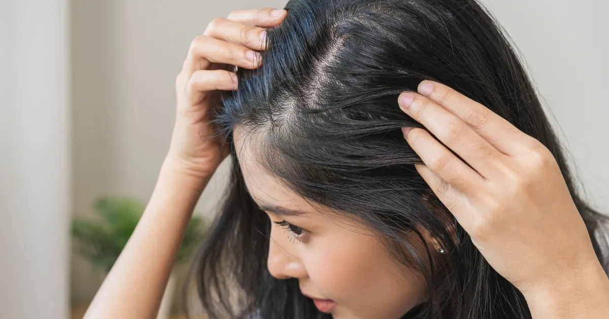 Panduan Lengkap Alopecia dari Ahli: Gejala, Pemicu & Solusinya