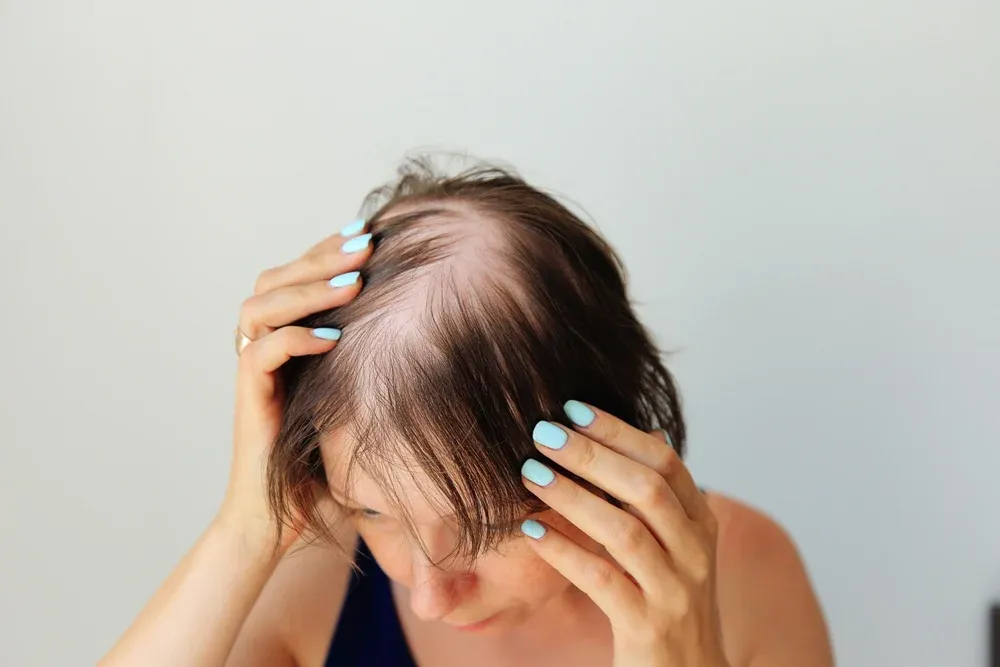 Alopecia Penyakit Apa? Kenali Gejala dan Solusi Tepatnya di Sini