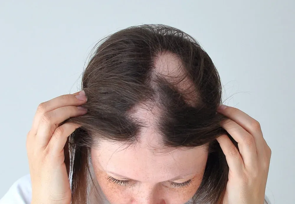 Apa Itu Alopecia? Pahami Penyebab Kebotakan Akibat Autoimun