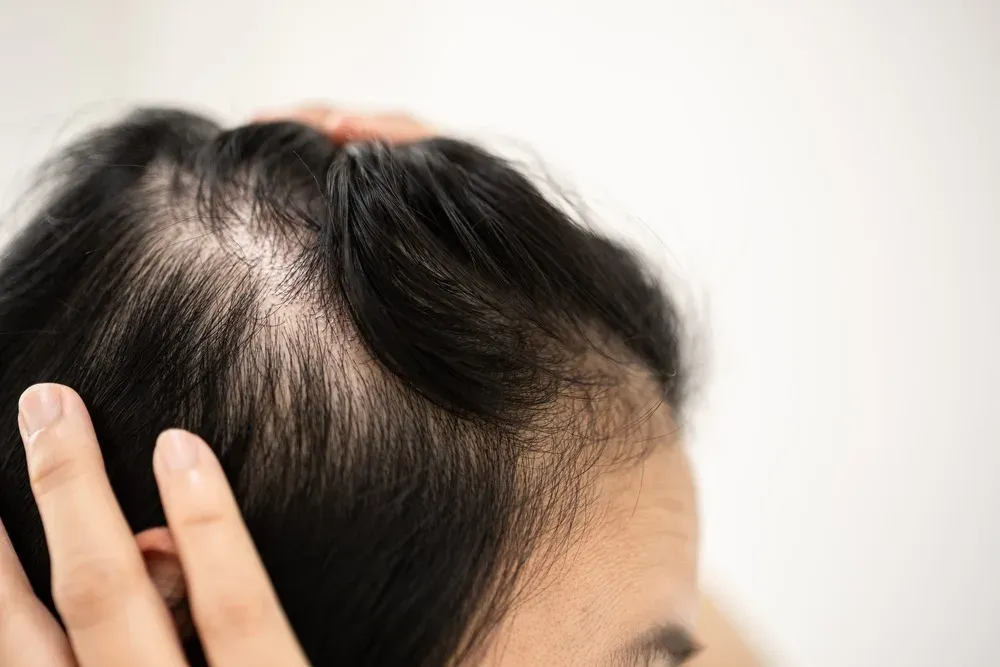 Apa Itu Alopecia Areata & Kenapa Bisa Terjadi? Ini Penjelasan Ahli