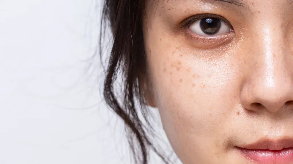 Mengapa Flek Hitam Susah Hilang? Ini Jawaban & Solusi Lengkapnya