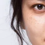 Facial Treatment untuk Flek Hitam dan Warna Kulit Tidak Merata