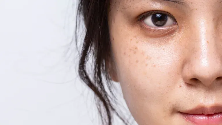 Mengapa Flek Hitam Susah Hilang? Ini Jawaban & Solusi Lengkapnya