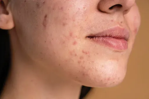 Cara Hilangkan Bekas Jerawat Sesuai Jenisnya, Treatment Tepat