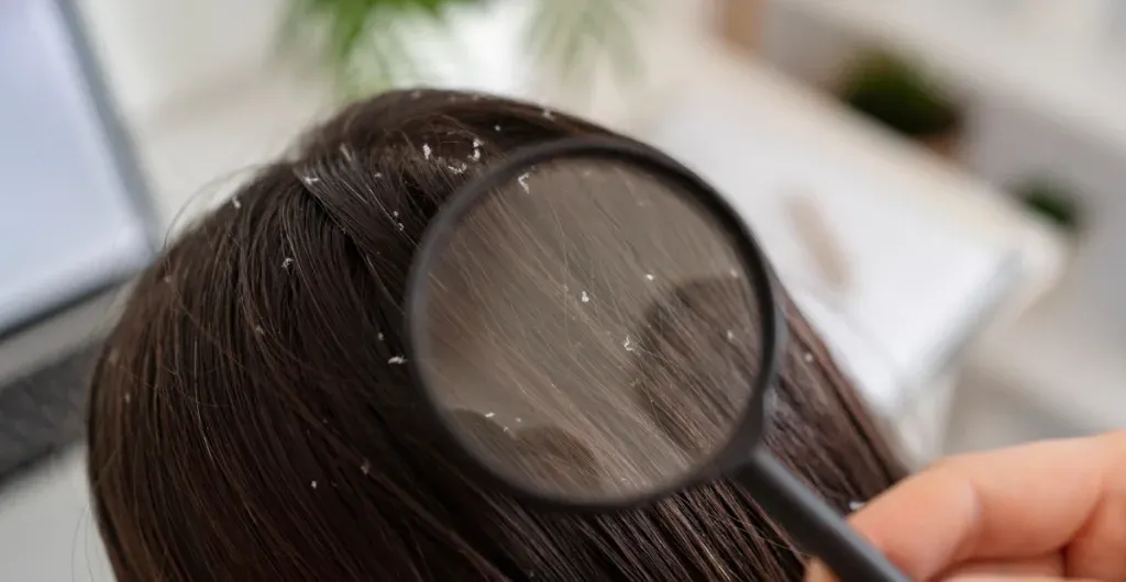 Solusi Tuntas Atasi Dandruff di Jakarta dari Ahli Kulit Profesional