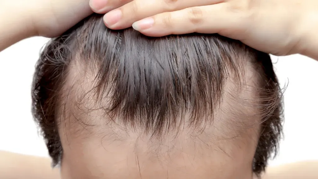 Rambut Makin Tipis? Kenali Apa Itu Androgenetic Alopecia & Solusinya