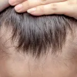Apa Itu Androgenic Alopecia? Penyebab, Gejala, & Cara Penanganannya!