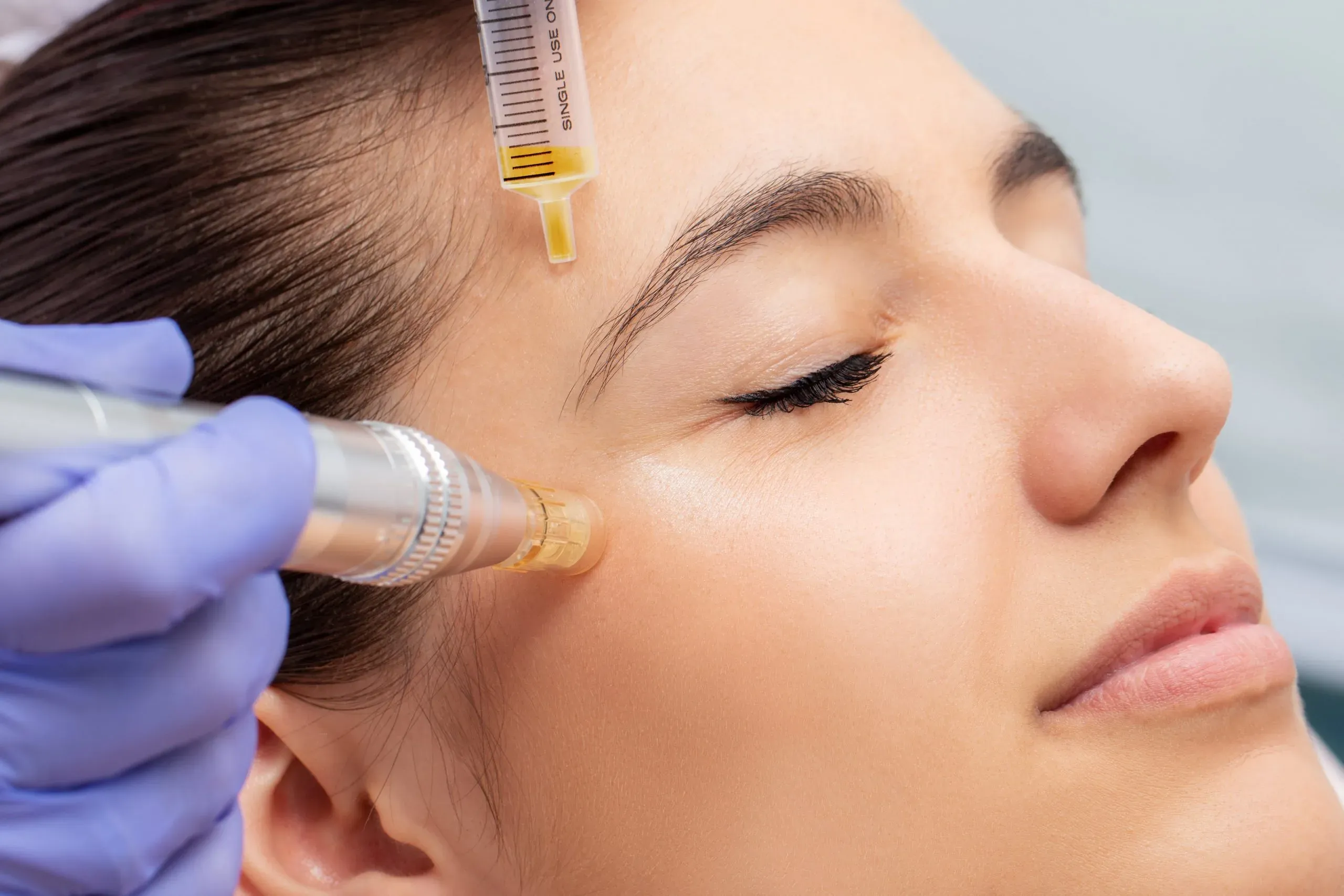 4 Manfaat Utama Meso Treatment untuk Wajah Glowing & Sehat