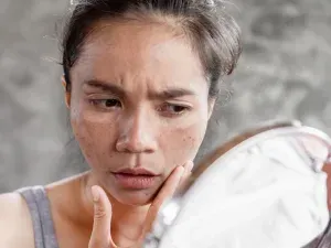 cara menghilangkan flek hitam di wajah