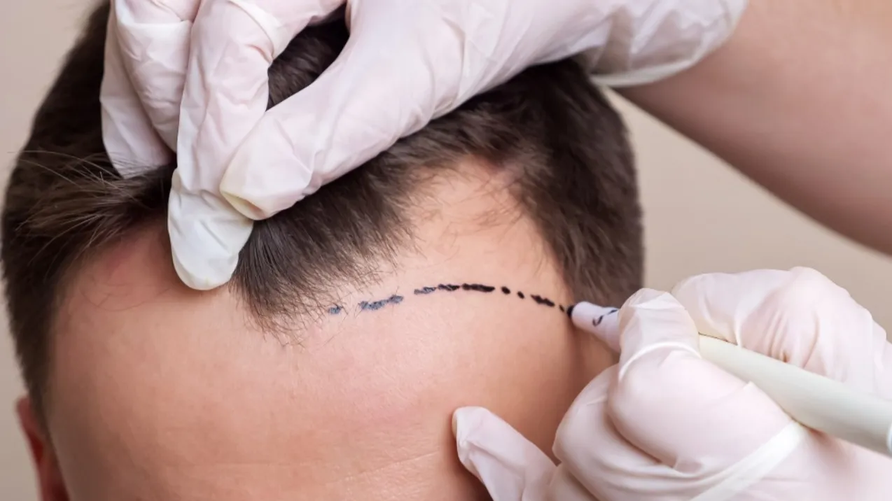 Berapa Biaya Transplantasi Rambut? Ini Faktor Penentunya!
