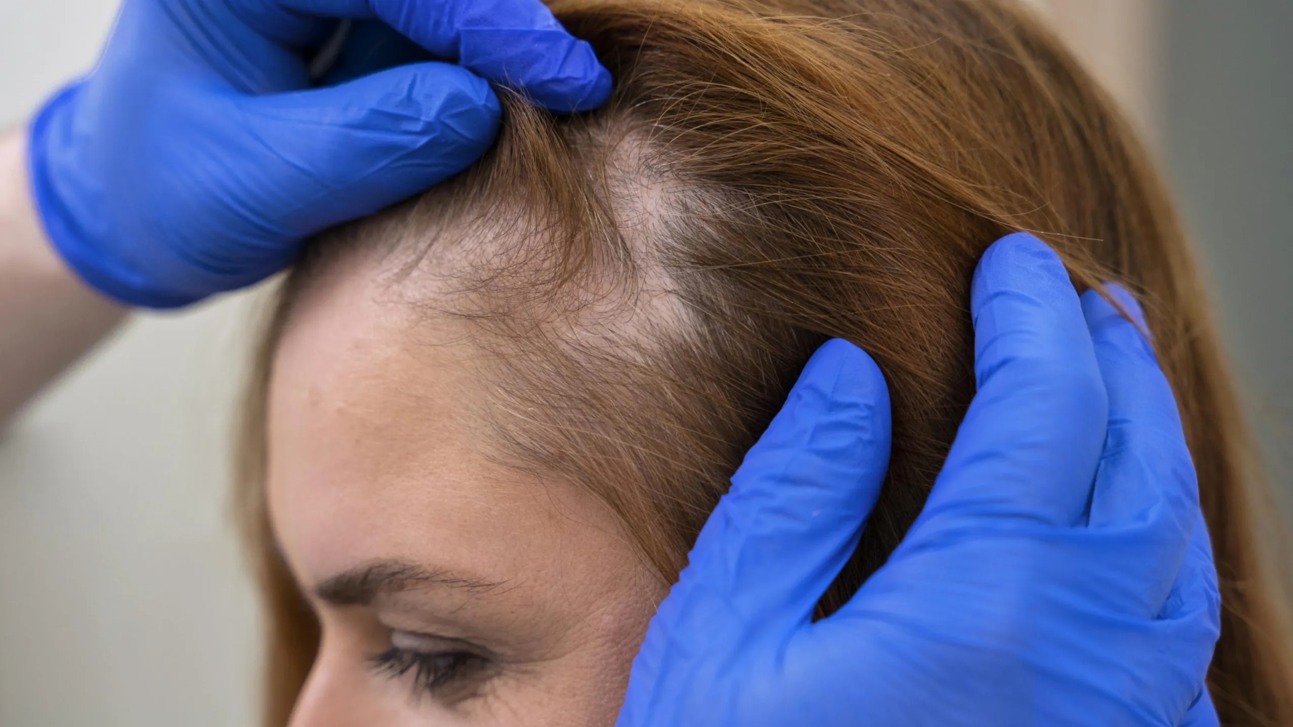 Berapa Estimasi Biaya Tanam Rambut FUE, FUT & DHI di Indonesia?