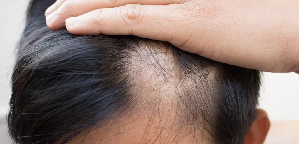 Mengalami Gejala Penyakit Alopecia? Ini Cara Mengatasinya