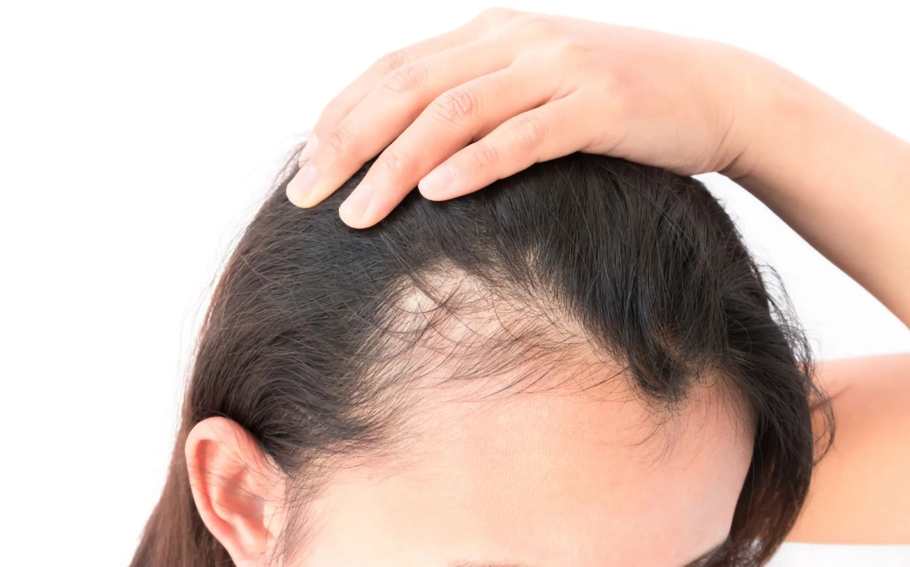 Kenapa Rambut Rontok Parah dan Terus Menipis? Ini Cara Tepat Mengatasinya