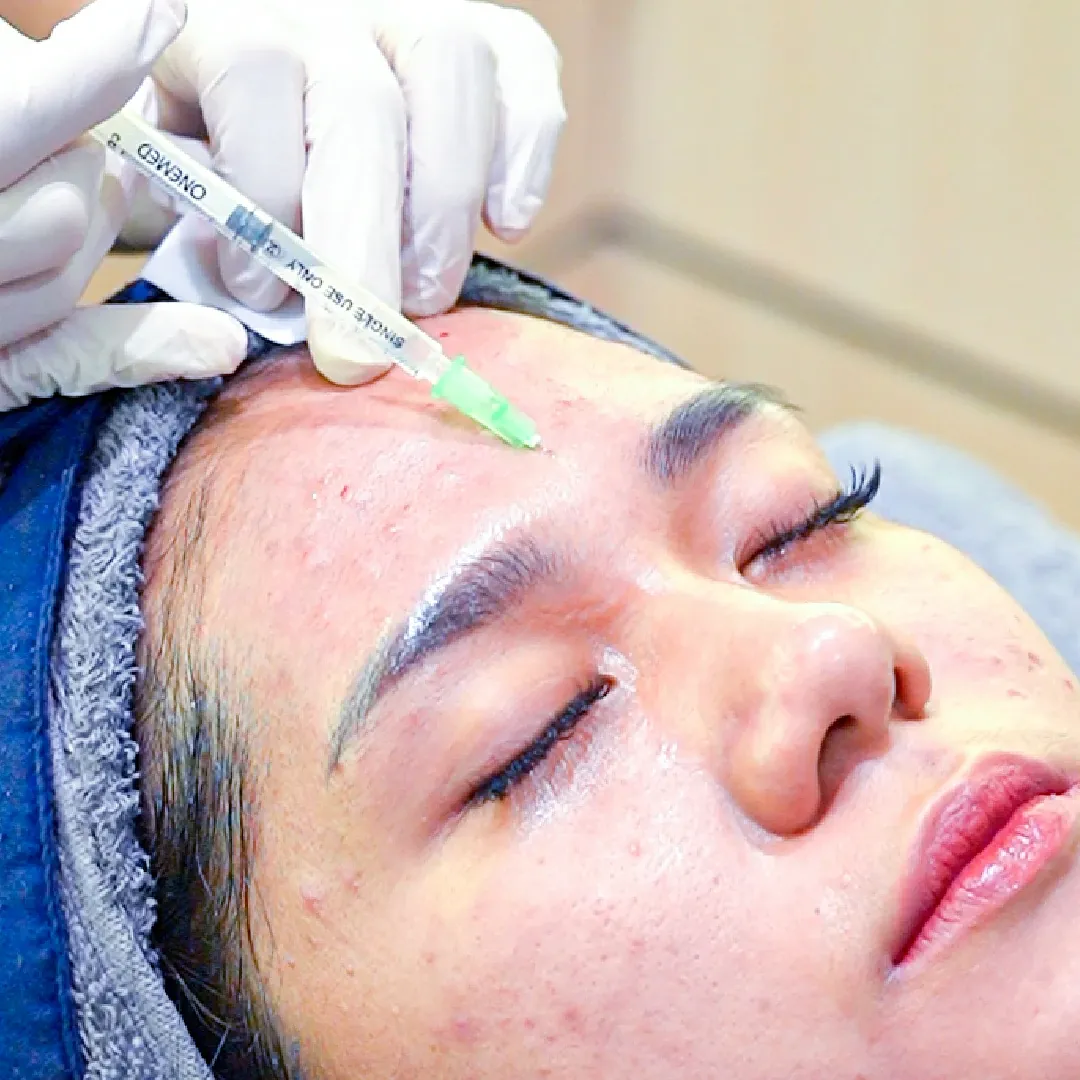 Acne Microbotox 40 IU Treatment
