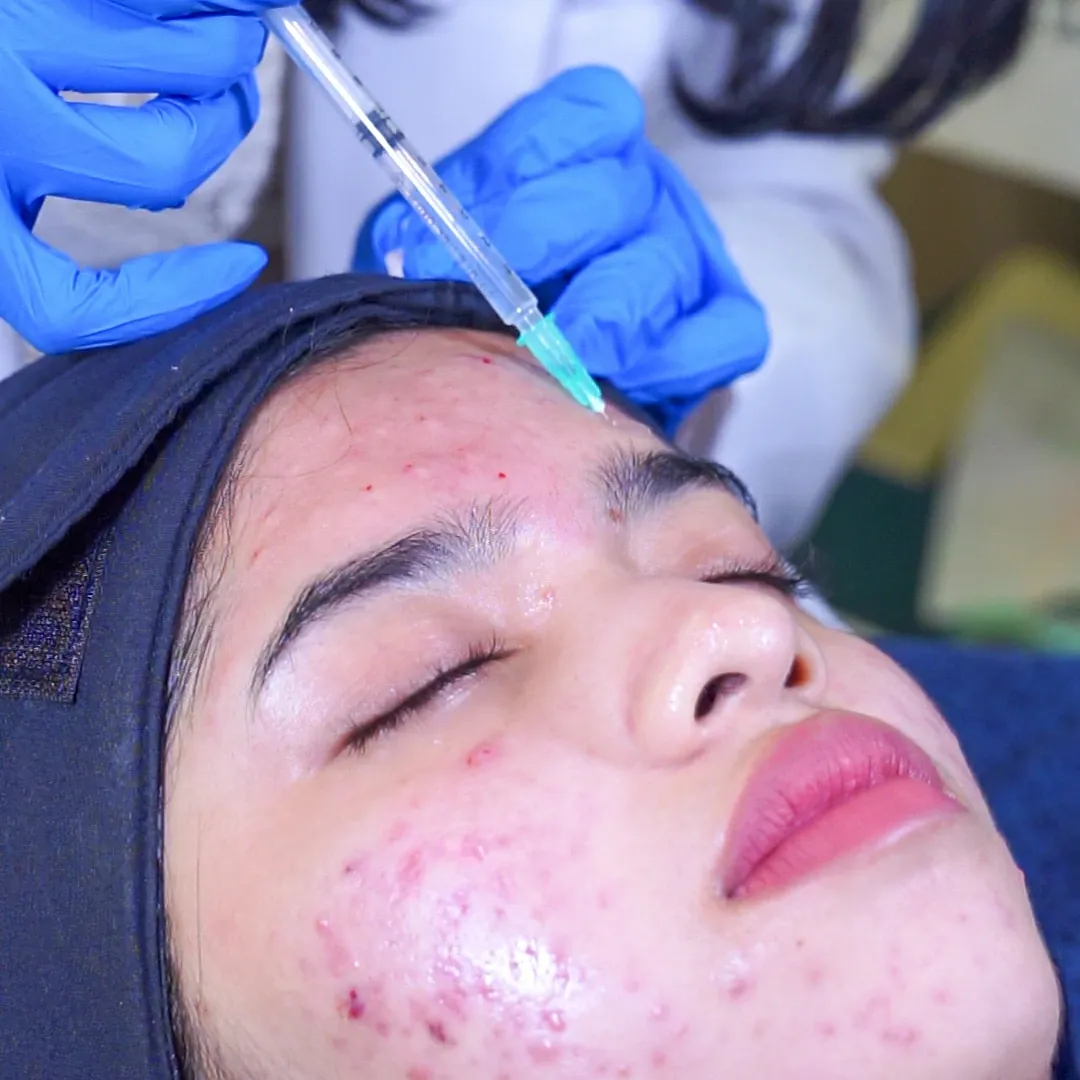 Acne Microbotox Skinbooster Treatment