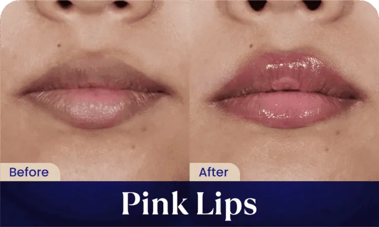hasil-pink-lips-treatment-sozo