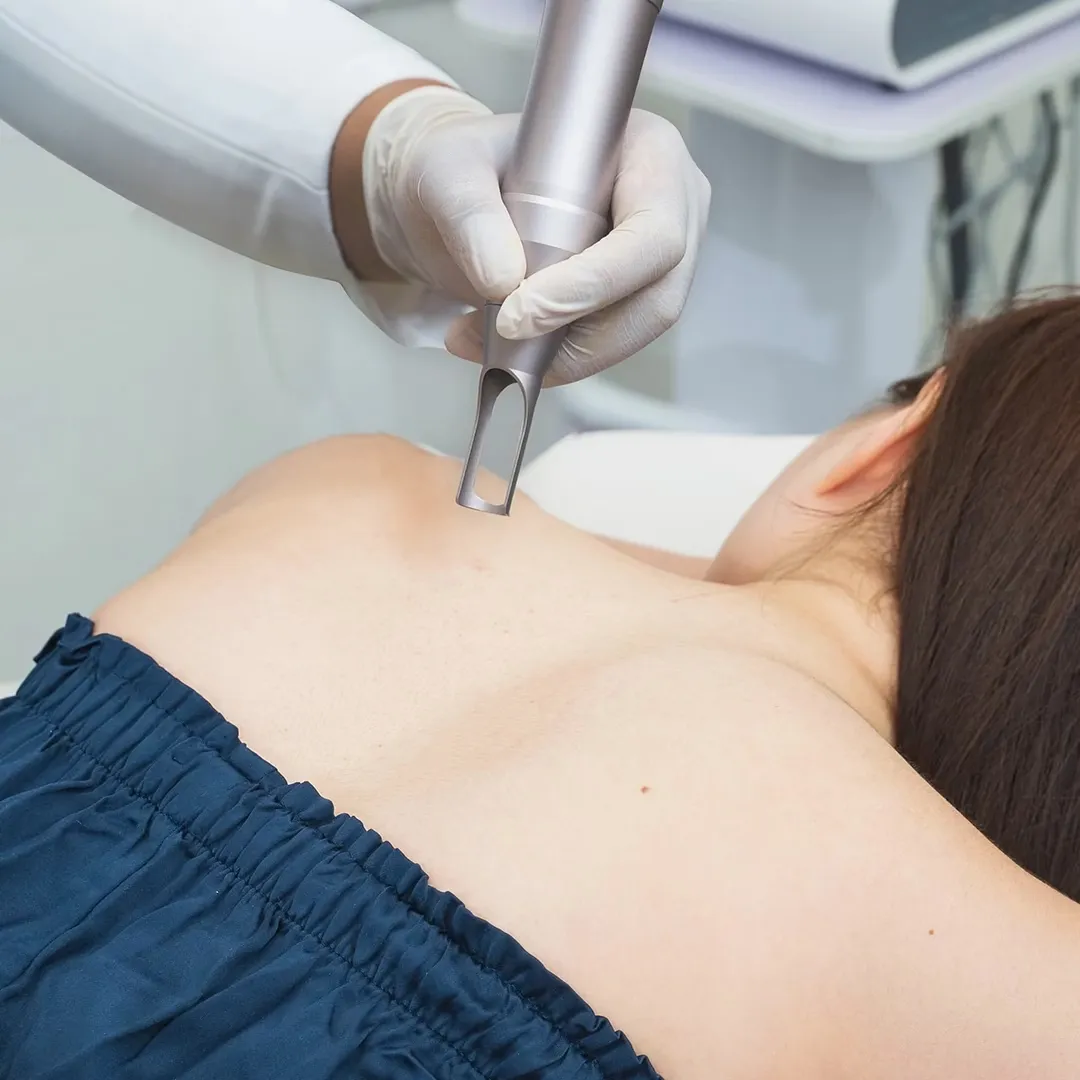 Body rejuve laser