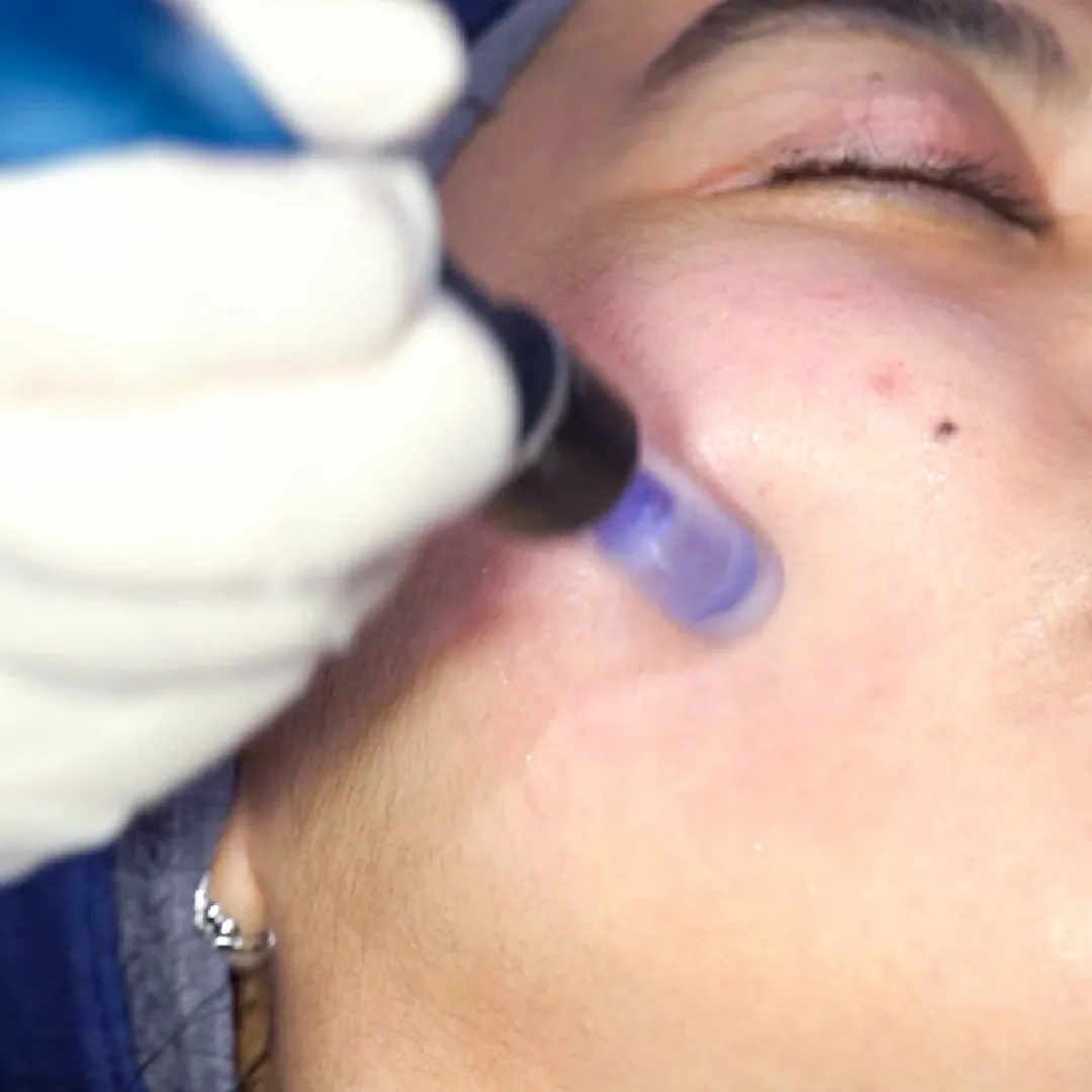 Glow Reset Laser Facial - Rejuran Shine