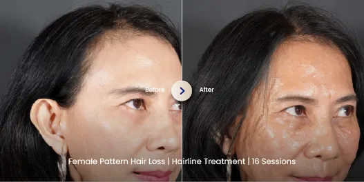 Before After Rambut Rontok