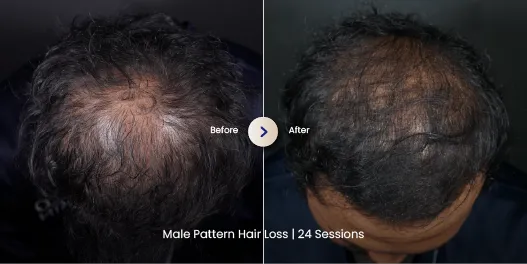 Before After Penipisan Rambut Pria PRP SOZO Skin Clinic