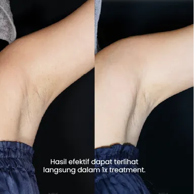 hasil treatment yang efektif dan instan di sozo