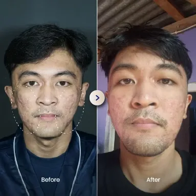Hasil Nyata Before After Laser Treatment Sozo Skin Clinic 2