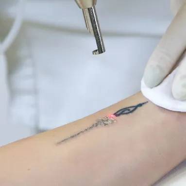 Laser Tattoo Removal