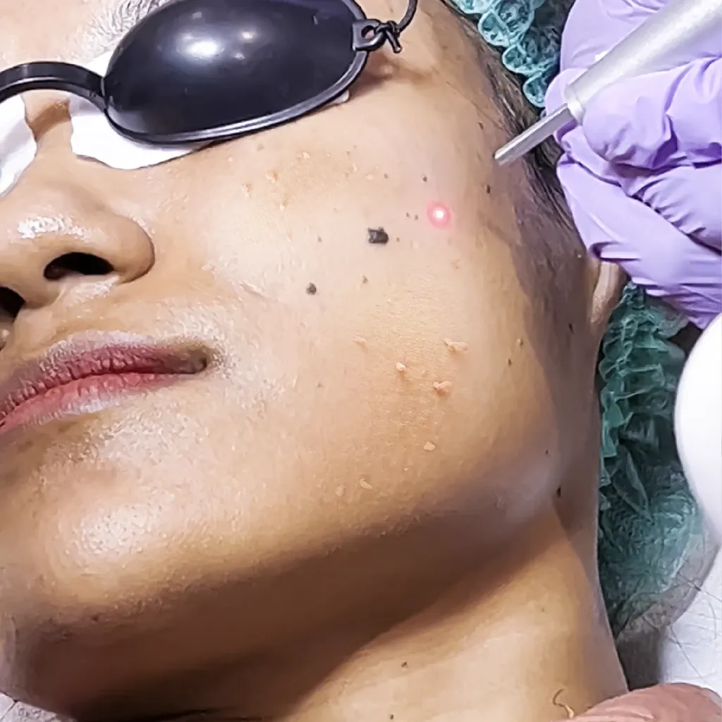 Laser CO2 - Skin Tag (Per Area)~1