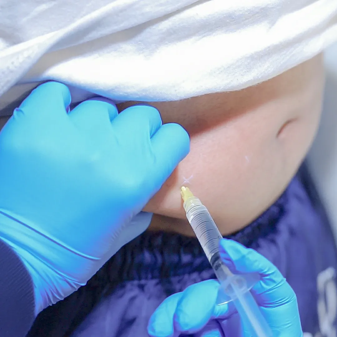 Subcision Treatment Sozo Skin Clinic