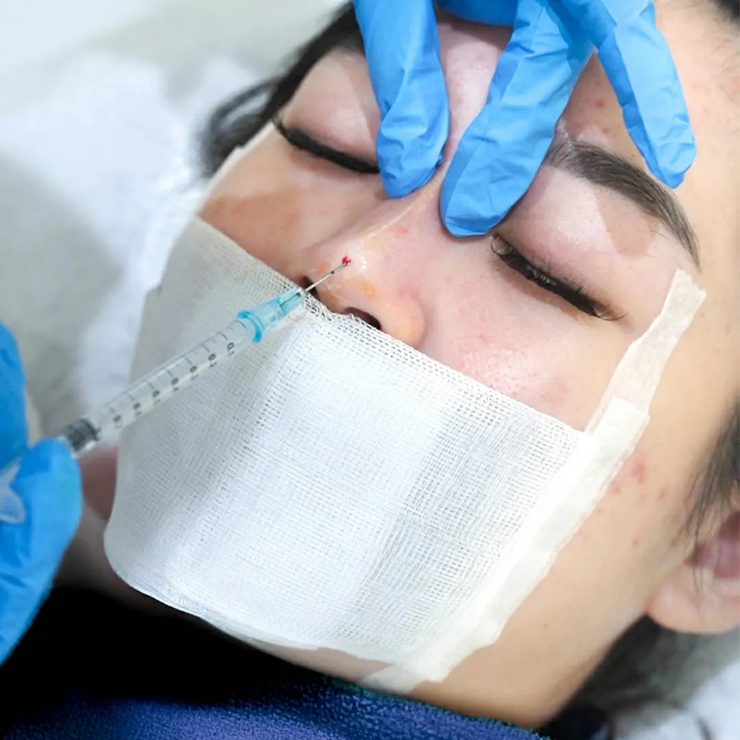 Tanam benang hidung untuk hidung mancung di Sozo Skin Clinic