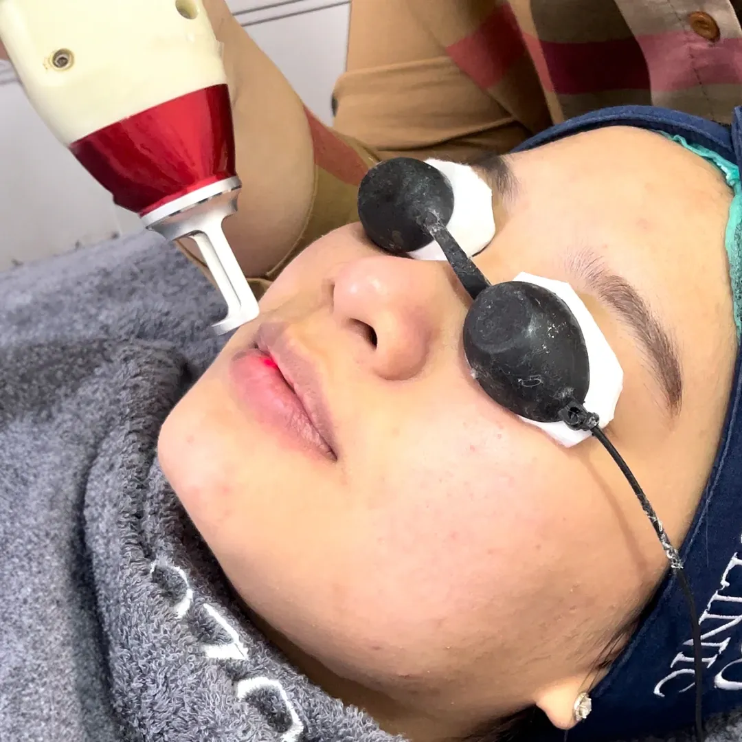 Pink Lips Laser