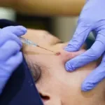 Subcision Treatment: Prosedur, Manfaat, dan Efek Sampingnya