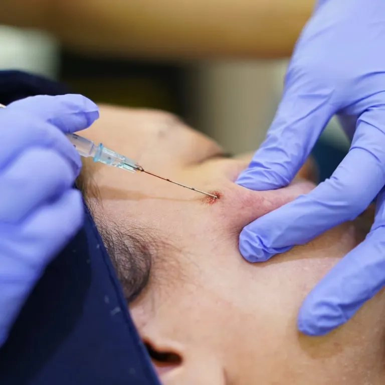 Subcision Treatment: Prosedur, Manfaat, dan Efek Sampingnya