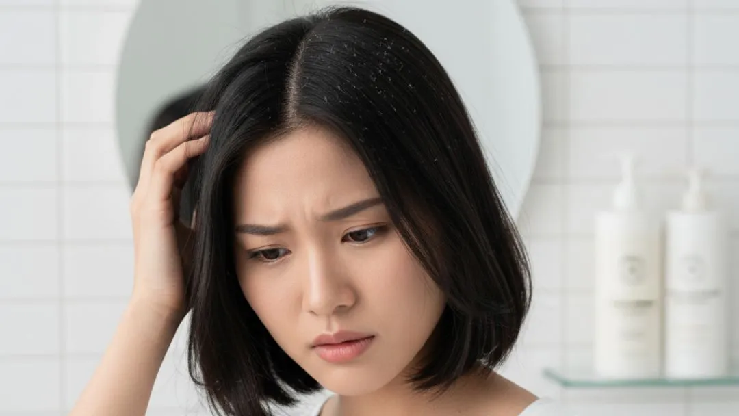 6 Penyebab Utama Ketombe yang Wajib Kamu Tahu & Cara Mengatasinya