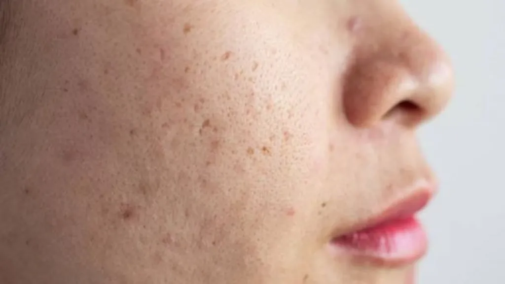 Cara Efektif Menghilangkan Bopeng: Perawatan Jangka Panjang di Sozo Skin Clinic