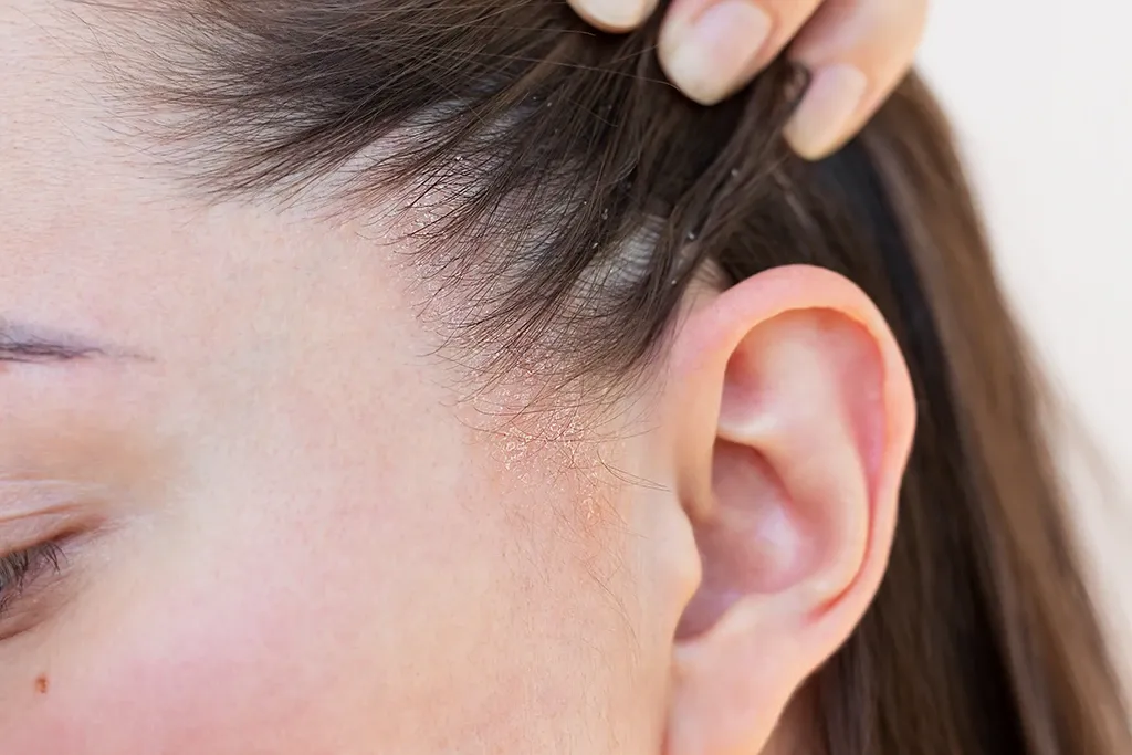 Perawatan Dermatitis Seboroik di Jakarta: Solusi Terpercaya untuk Kulit Bermasalah