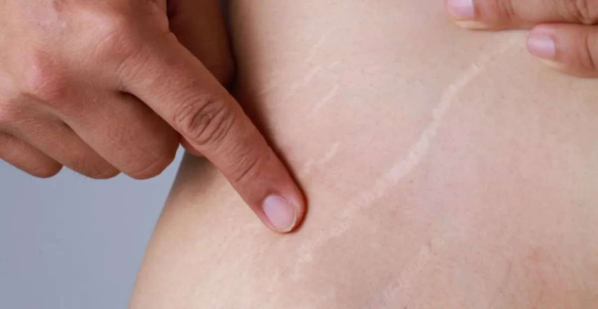 Stretch Mark Muncul? Ini Solusi Jitu Agar Kulit Tetap Mulus