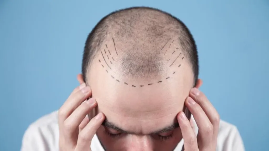 Transplantasi Rambut atau Hairline Design? Pahami Perbedaan & Kebutuhannya!