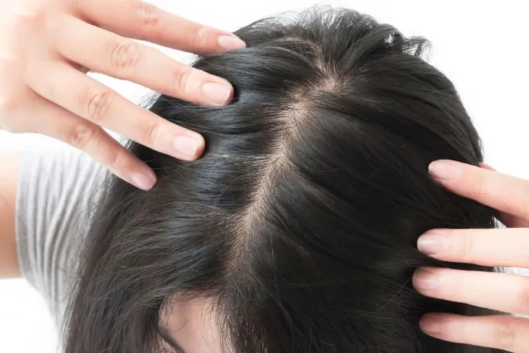Kenapa Rambut Tipis Padahal Masih Muda? Ini Penyebab & Solusi Medisnya