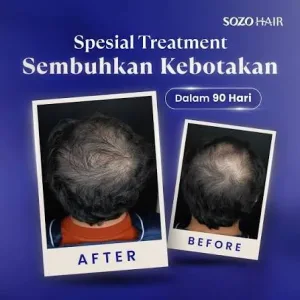 Hasil Hair Treatment di Sozo Skin Clinic