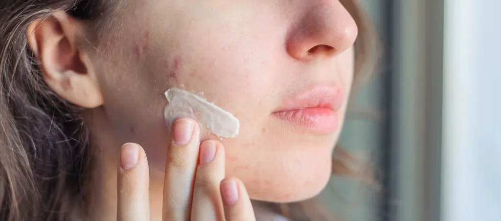 Salicylic Acid untuk Apa? Kupas Tuntas Rahasia Bebas Jerawat & Komedo di Sini