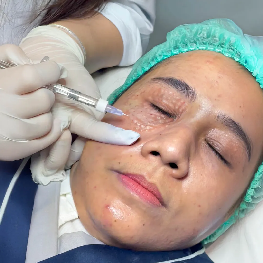 Rejuran Eye Treatment Sozo Skin Clinic