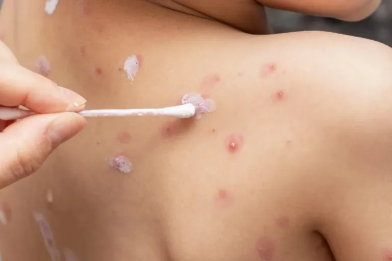 Cara Mencegah Cacar Air Agar Tidak Bertambah Banyak & Cepat Kering