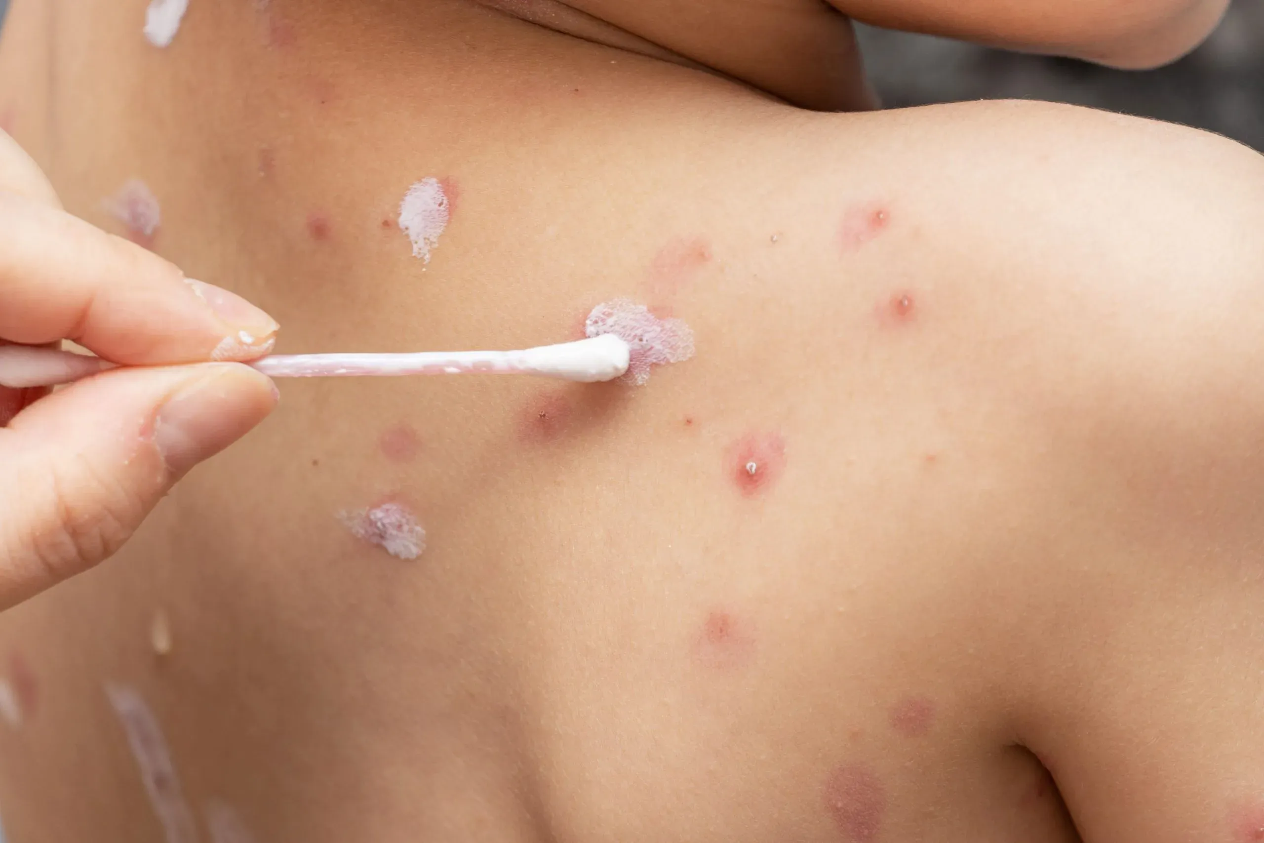 Cara Mencegah Cacar Air Agar Tidak Bertambah Banyak & Cepat Kering