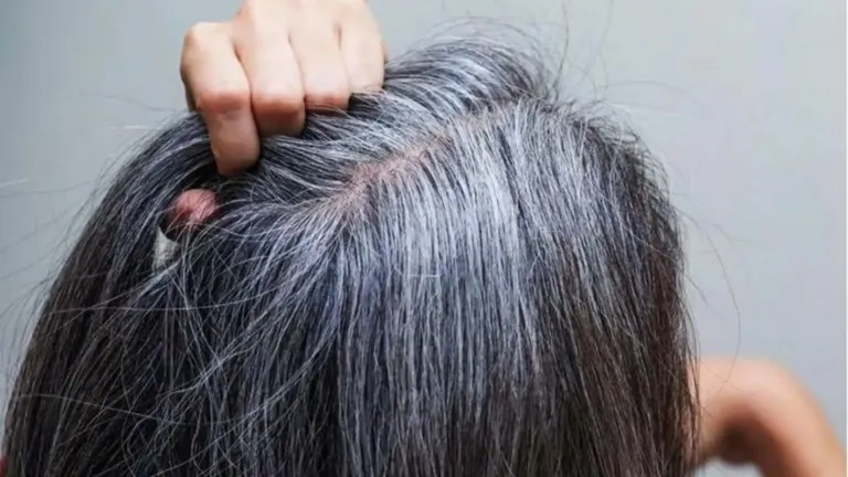 Muncul Uban di Umur 20-an? Cara Mengatasinya Tanpa Cat Rambut