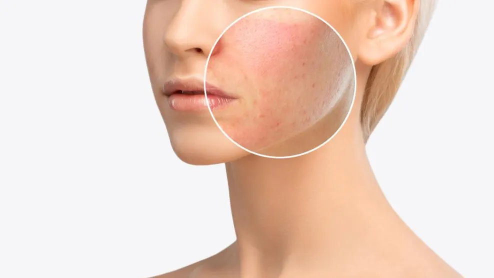 Comedogenic Adalah Masalah Kulit, Bukan Label Produk