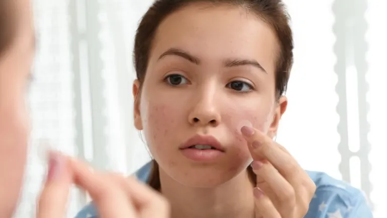 Fungsi Acne Patch dan Cara Menggunakannya dengan Benar
