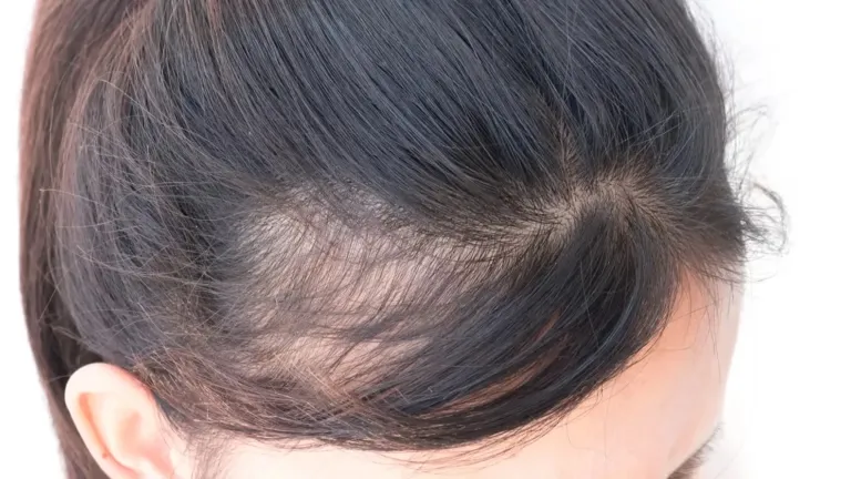 Kenali Jenis Hairline Kamu dan Cara Merawatnya dengan Tepat