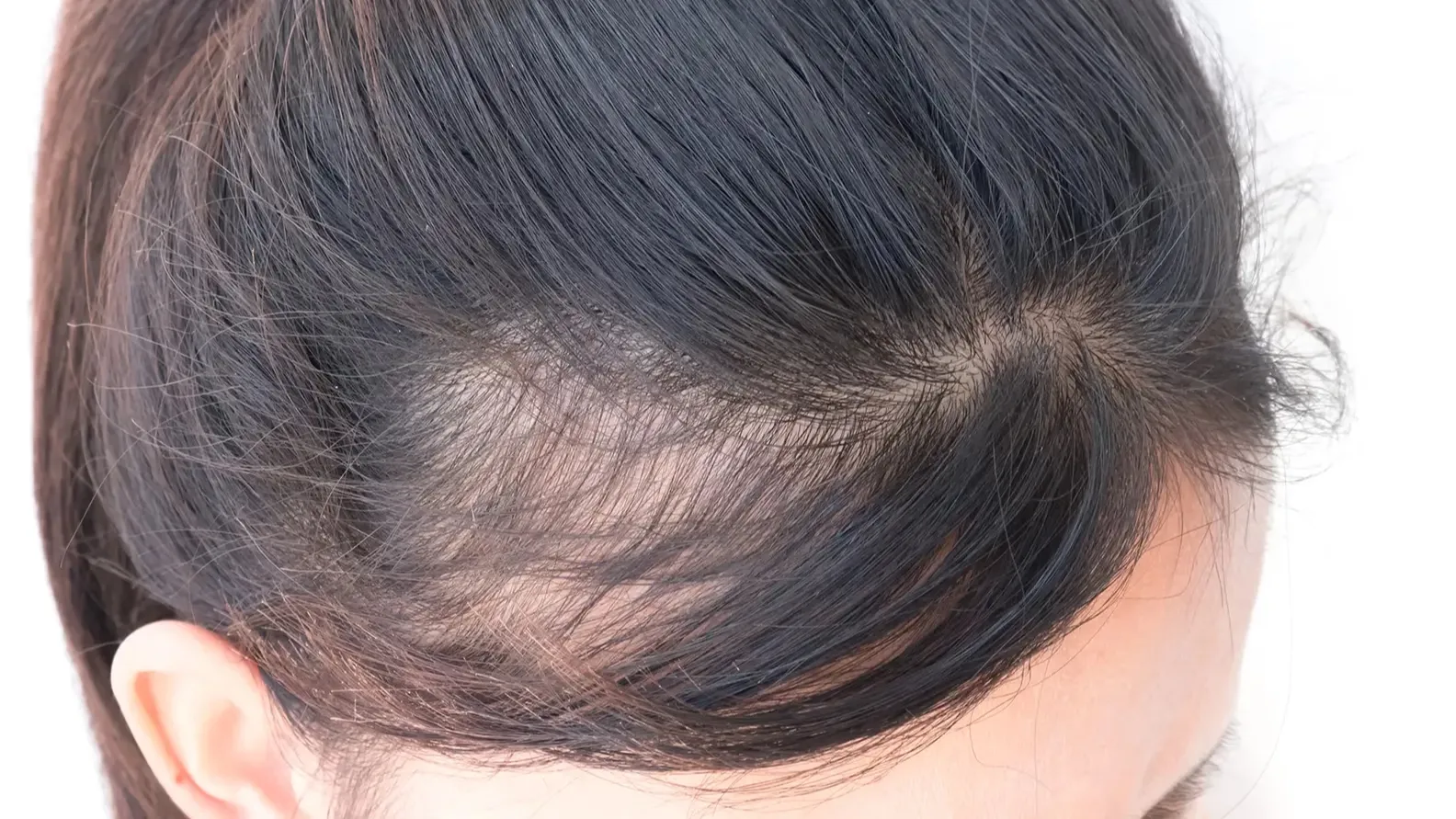 Kenali Jenis Hairline Kamu dan Cara Merawatnya dengan Tepat